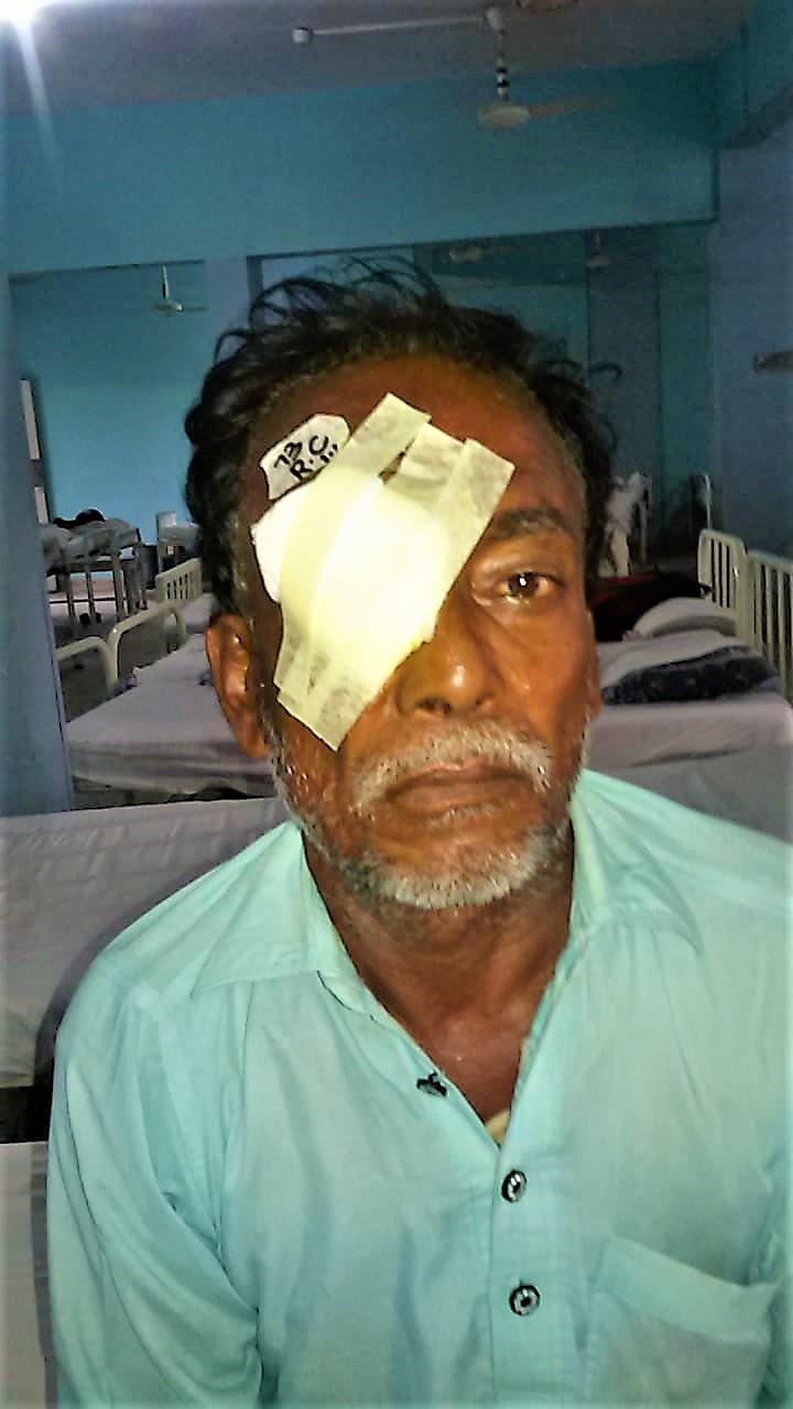 oye surgery LRBT edited